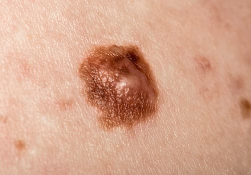 recognise-skin-cancer-article