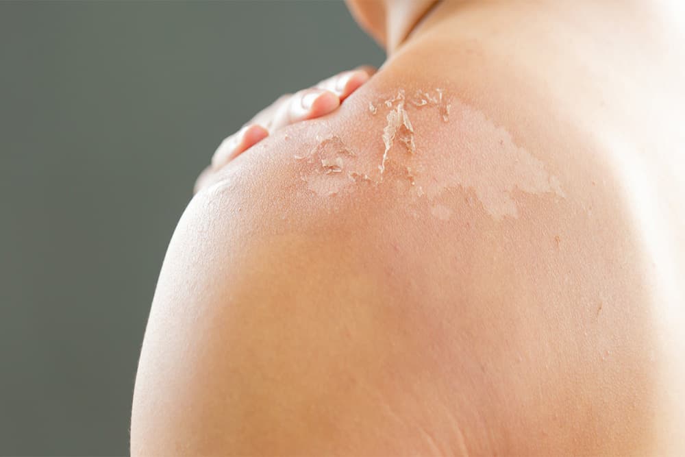 signs-of-skin-cancer-sunburn-article