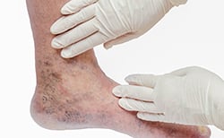 ankle with gloved hands touching the veins