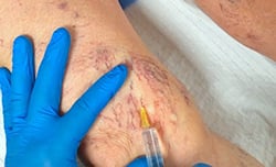 up close image of knee with thread veins being injected