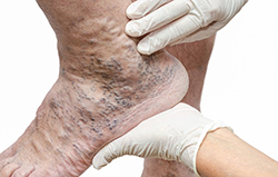 An example of extensive ankle blue veins (Corona Phlebectatica) with visible feeding varices (Varicose Veins).