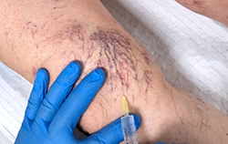thread veins pre injection, showing purple