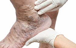 up close image of ankle with blue varicose veins