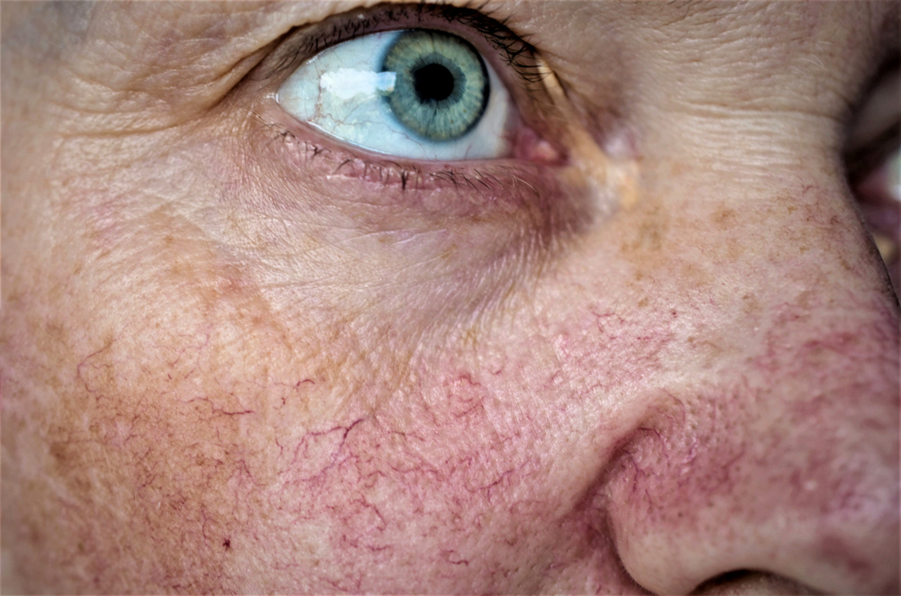 up close image of facial thread veins