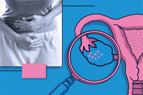 Woman holding her stomach with an image next to her of a cervix and ovaries