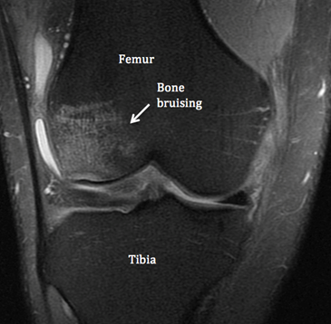 bone xray showing femur, tibia and bone bruising