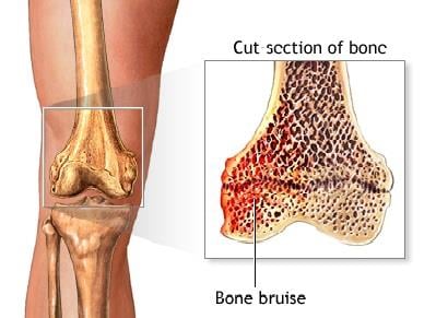 Cut section of a bone showing bruising