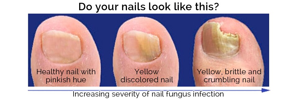 Fungal Nail Infections | Lasers | Ramsay Health Care UK