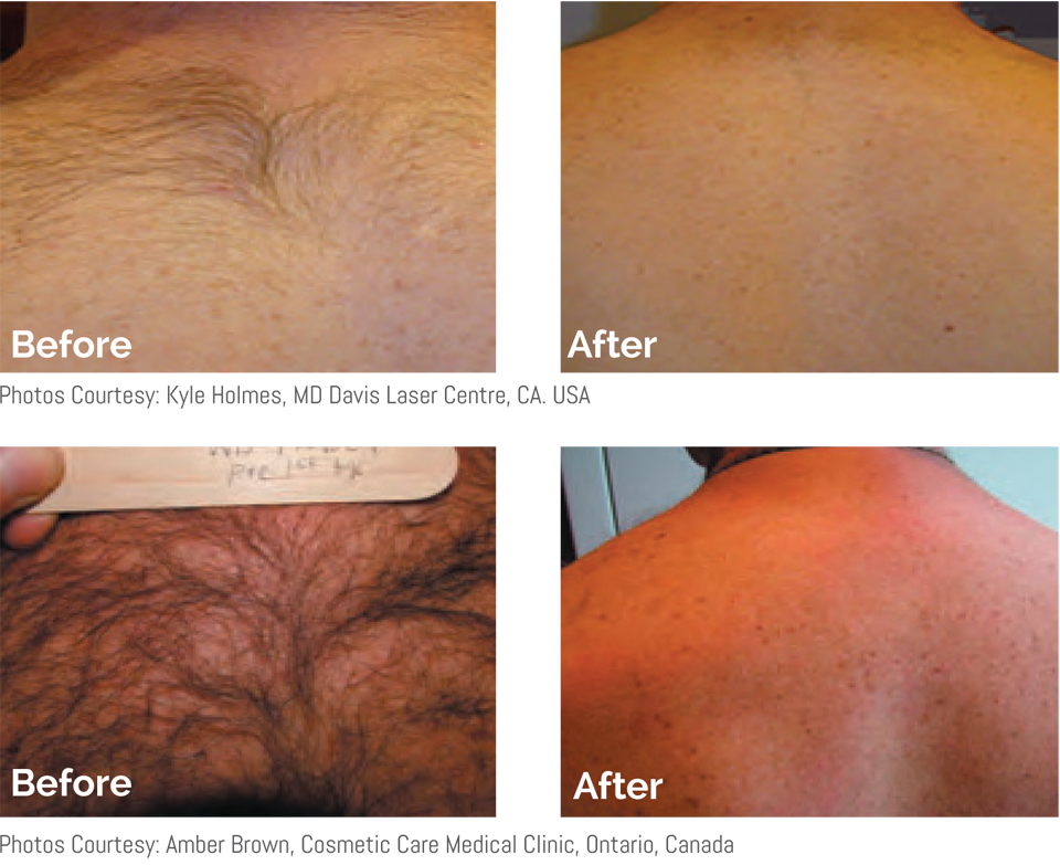 laser-hair-removal-for-men-one