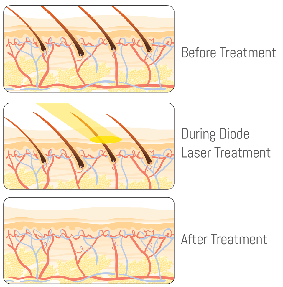 laser-hair-removal-for-men-three
