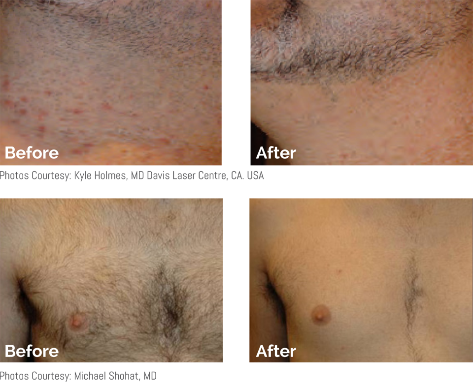 laser-hair-removal-for-men-two