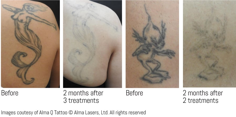 Tattoo removal chain Think Again inks a path to growth