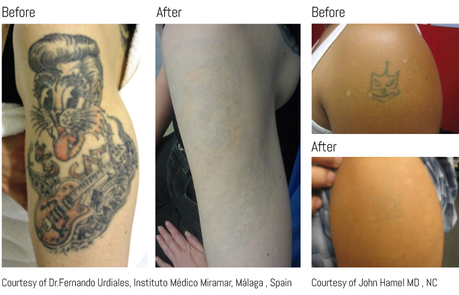 laser-tattoo-removal