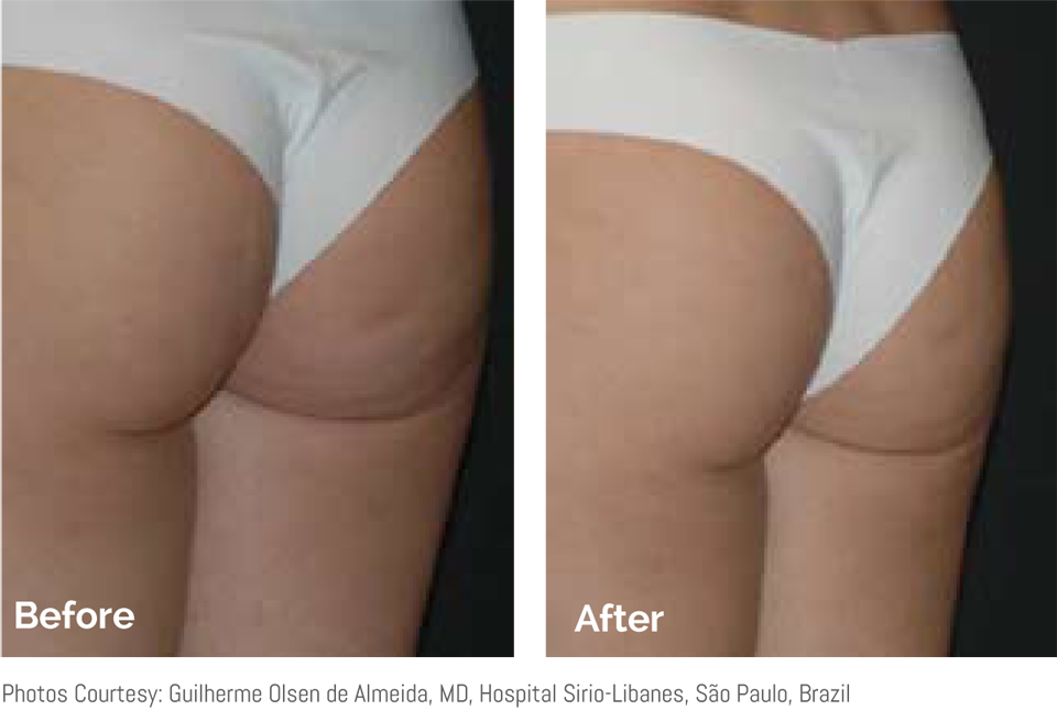 sopranos-skin-tightening-faq-butt