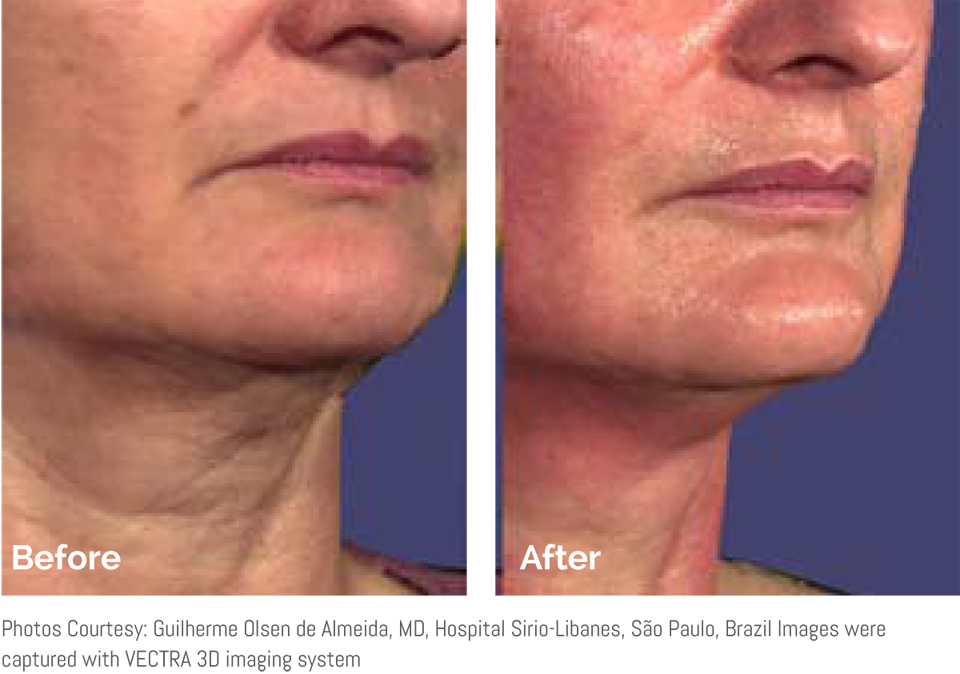 sopranos-skin-tightening-faq-face