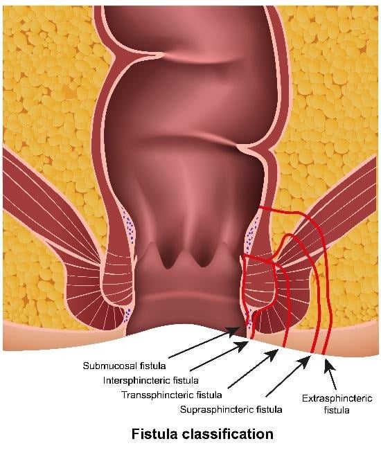Fistula classification diagram