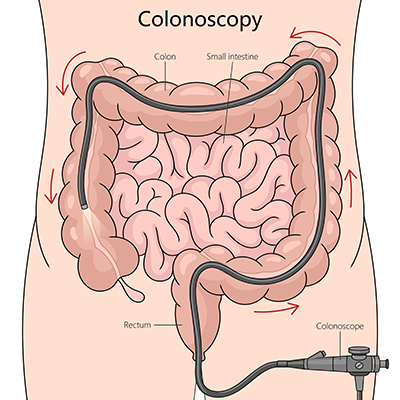 Colonoscopy Procedure