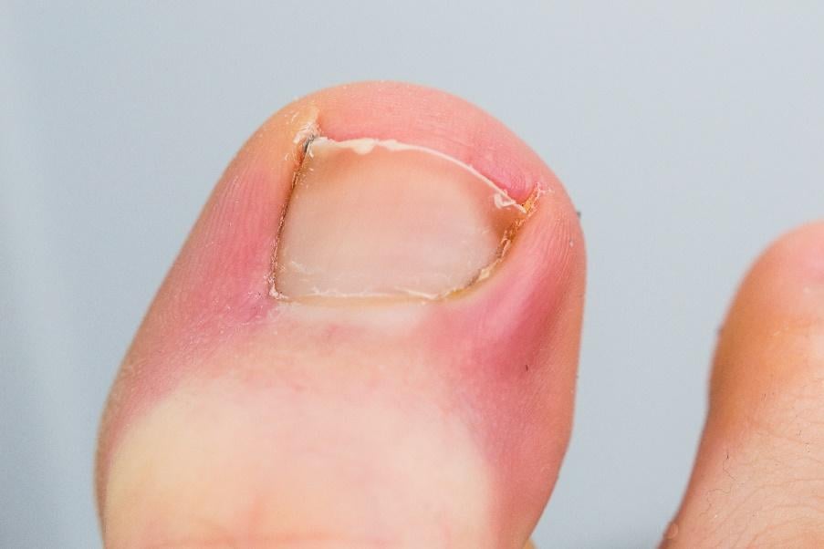 ingrown toenail